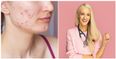 Dr Doireann O’Leary’s top tips on managing acne prone skin and breakouts