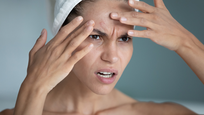 Dermatologist reveals the type of spot you really should leave alone