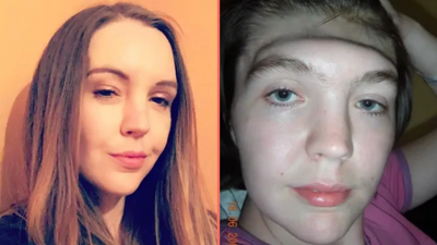 Woman warns against putting feet on dashboard after she lost entire forehead