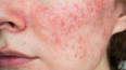 Her Health: HSE issues warning about rosacea triggers