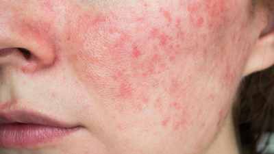 This common habit can make rosacea worse