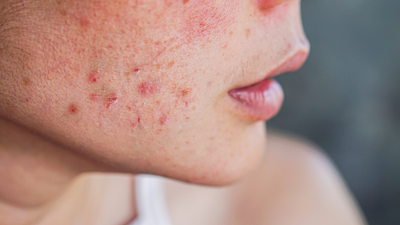 This daily habit may be causing your skin to break out