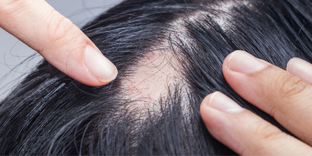 Irish woman turns her hair loss ‘into a positive story’ and is now helping others