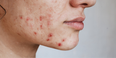 ‘Is Trentinoin going to clear my acne?’ – Dermatologist answers widely asked skincare question