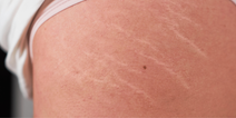 ‘Only two things work’ – Dermatologist reveals how to actually treat stretch marks