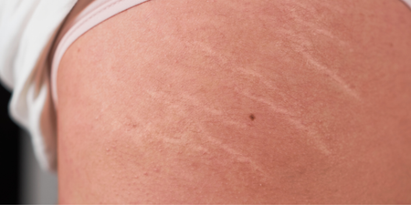 ‘Only two things work’ – Dermatologist reveals how to actually treat stretch marks