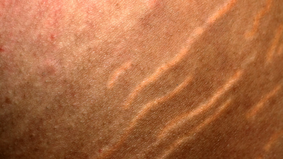 ‘The results can be amazing’ – Irish aesthetician explains how to treat stretch marks