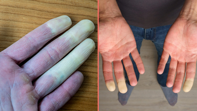 Millions of women suffer common disease where fingers turn white during winter months