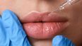 Everything you need to know before getting lip filler