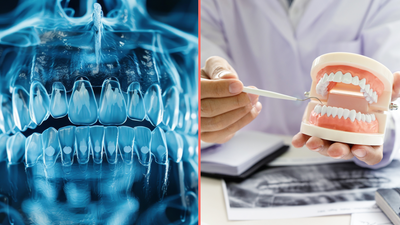 Cause of Alzheimer’s might be coming from inside your mouth, scientists find