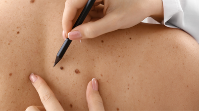 Skin cancer survival rates are improving in Ireland