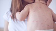 Warning issued after suspected case of measles at Dublin creche