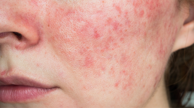 Rosacea
