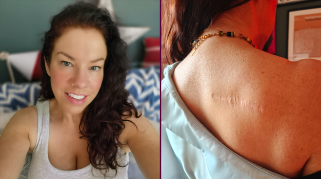 Skin Cancer Survivor Sunbeds