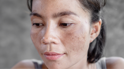 Why you need to wear SPF on your lips, according to a skincare expert